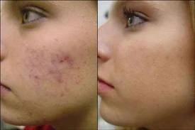 Microdermabrasie Zevenaar